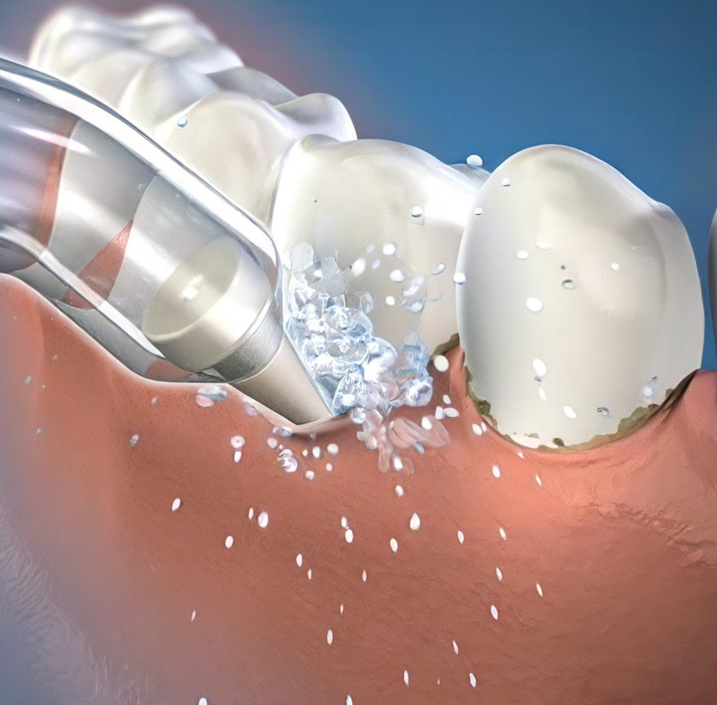 Pik Pocket™ Tips - Pack of 2