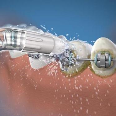 Orthodontic Tips - Pack of 2